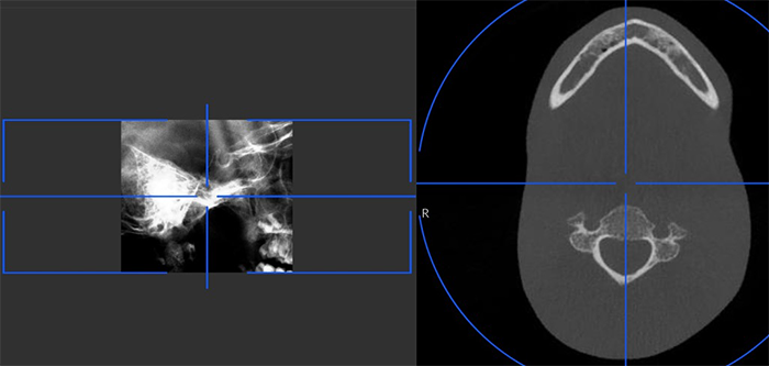 Scouter View Launching the X-Ray for 3D TMJ Images