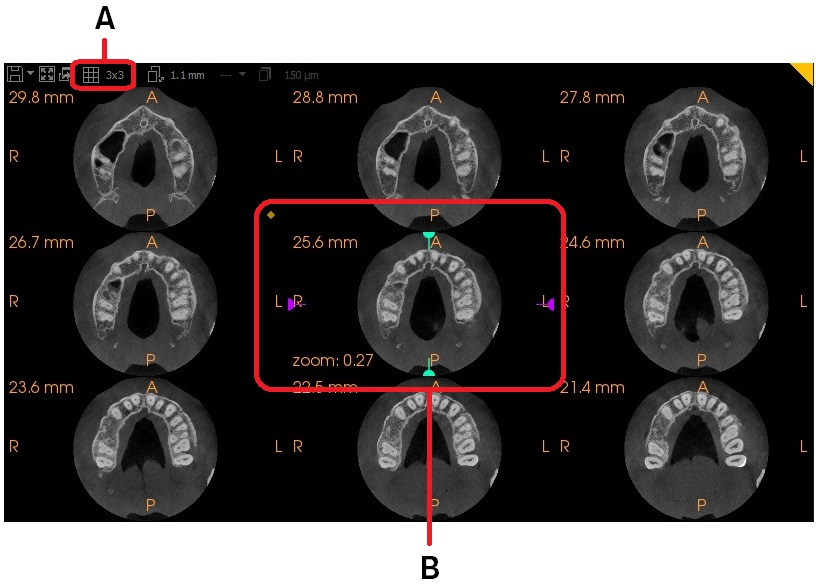 Using Split Views in 2D MPR Views