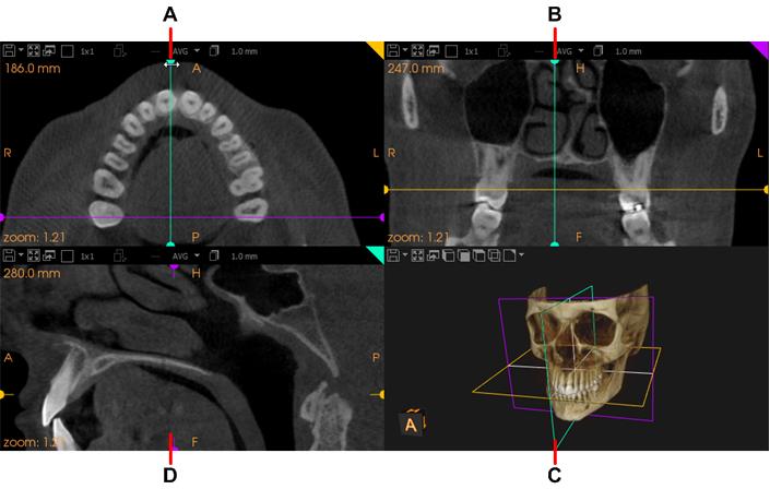 Moving a 2D MPR Plane Using a Handle