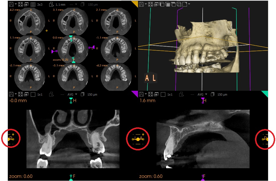 Understanding Slices in 2D MPR View Screens